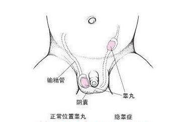 两个月宝宝睾丸积液，了解、关注与处理